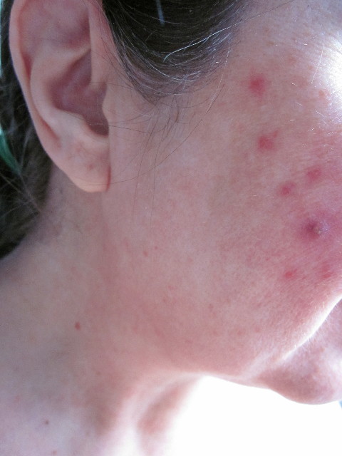 right cheek.jpg